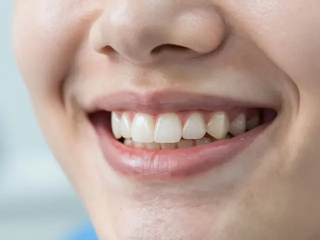 Fazety na přední zuby: Vše, co musíte vědět před zákrokem